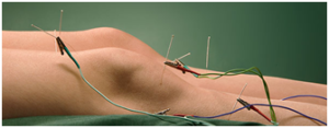 Electroacupuncture