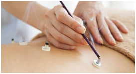 Moxibustion