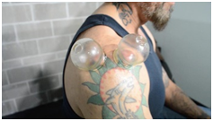 Myofascial Decompression / Cupping