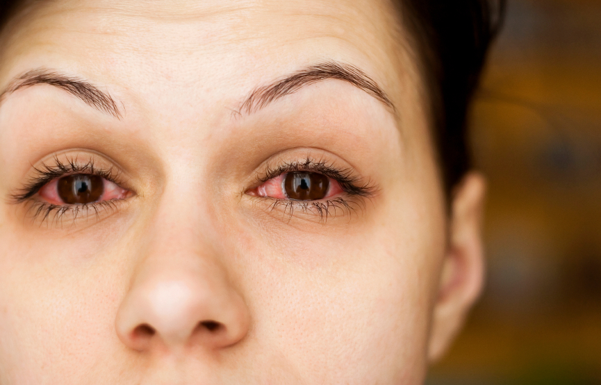 Treating Dry Eye with Acupuncture