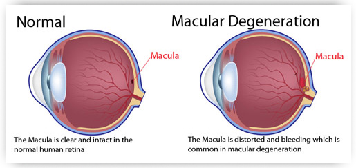 Acupuncture for Macular Degeneration